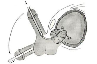 Scheme of endoscopic operation for penis enlargement
