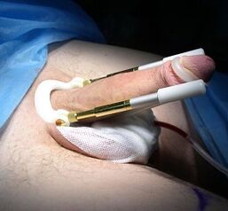How is the penis enlargement surgery performed