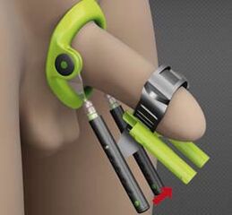 Rehabilitation after surgery to enlarge the penis