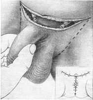 Surgical lengthening of the penis by pulling on its hidden part